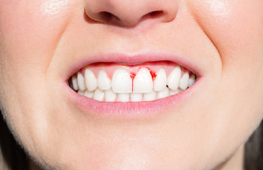 Quality Dental Services: Locating a Trusted Dentist for Healing Gum Bleeding